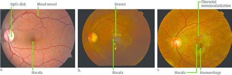 wet amd pubmed.